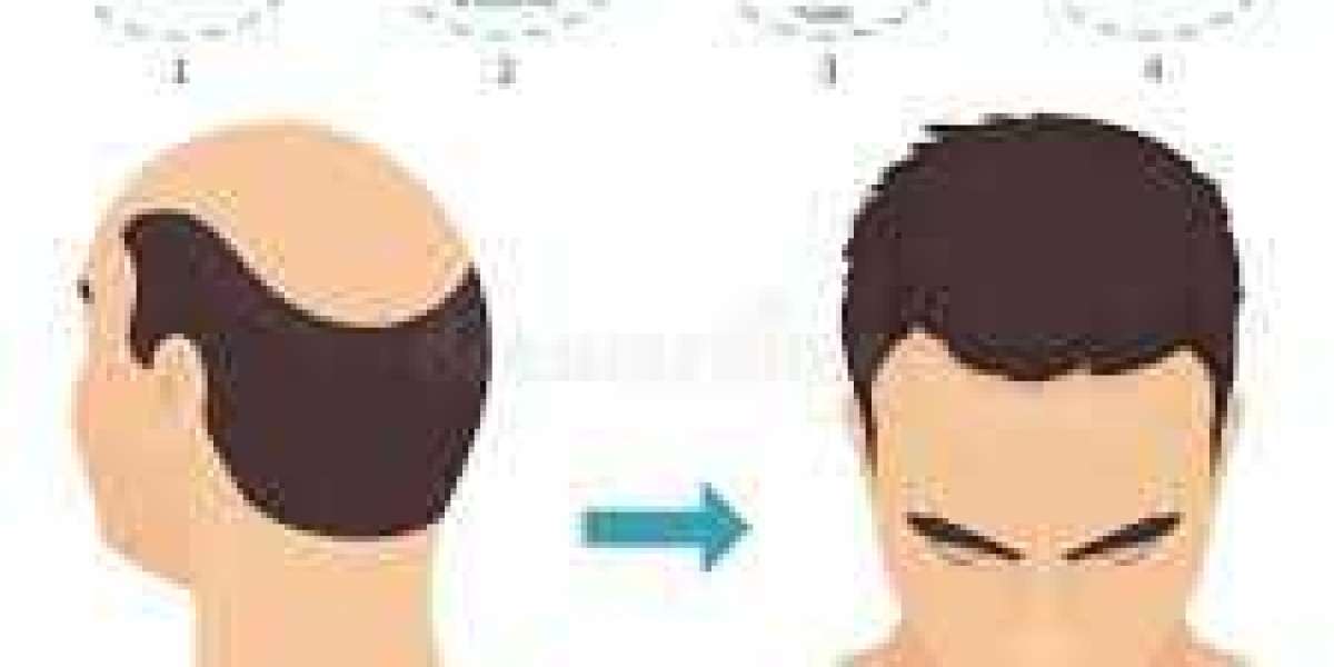 Hair Transplant in New Zealand